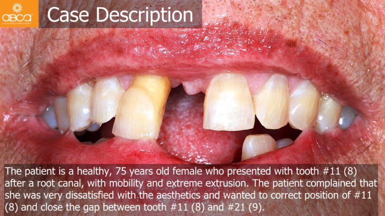 Immediate Loading in the Aesthetic Zone of Tooth 